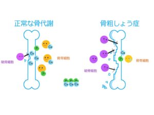 骨の健康～気づいたときが一番若い、今からしっかり骨の健康維持を意識していきましょう。～【吉田管理栄養士】